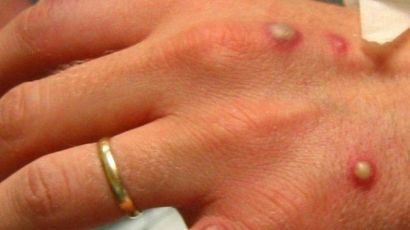 Casos suspeitos de monkeypox são descartados em SC